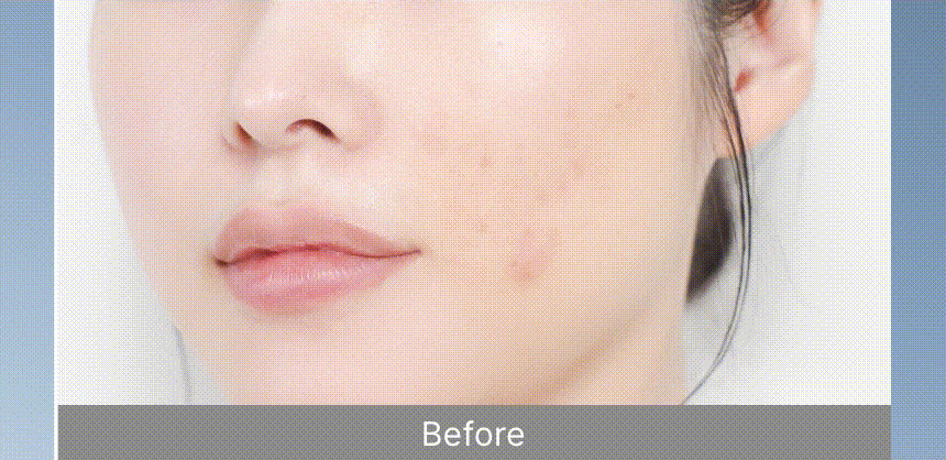 아줄렌안티블레미쉬2종세트(AZULENE ANTI BLEMISH SKIN CARE SET)